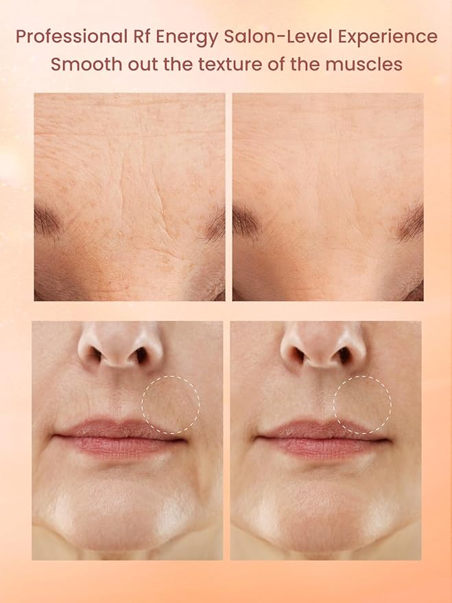 RF Radio Frequency Facial Device, 1MHz RF Machine - Image 7