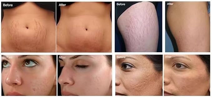 Anti-Aging Device, Wrinkle Reduction Beauty Care Equipment - Image 5