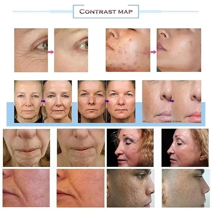 Anti-Aging Device, Wrinkle Reduction Beauty Care Equipment - Image 3